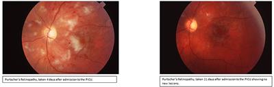 Juvenile Dermatomyositis (JDM) Complicated by Thrombotic Thrombocytopenic Purpura (TTP) and Purtscher's Retinopathy Responsive to Rituximab: Case Report and Literature Review